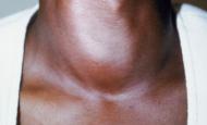 Lorsque la thyroïde se dérègle © Getty Images