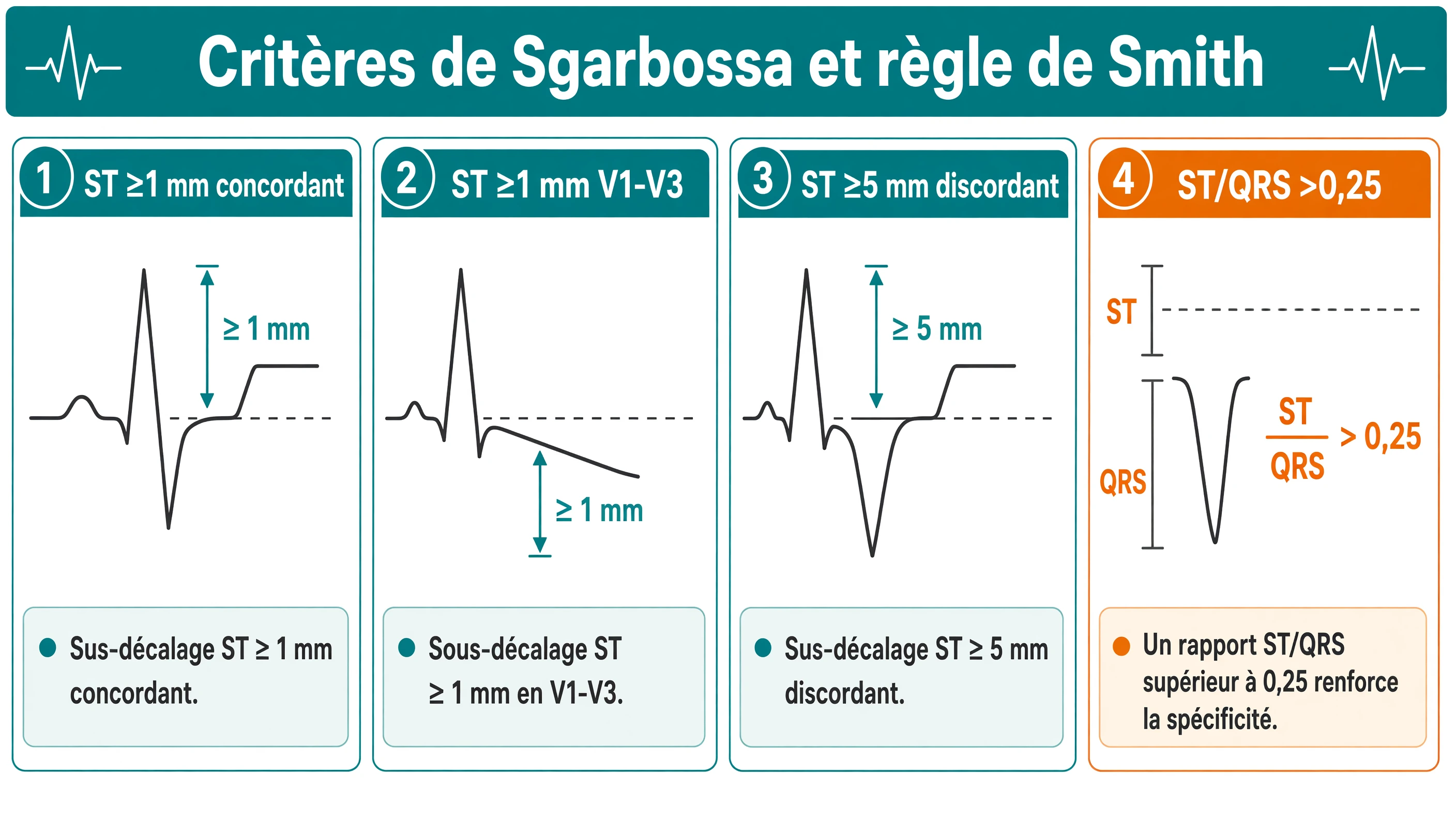 Quatre modules schématiques présentant les critères numériques de Sgarbossa et le seuil ST/QRS de Smith pour l’ECG stimulé