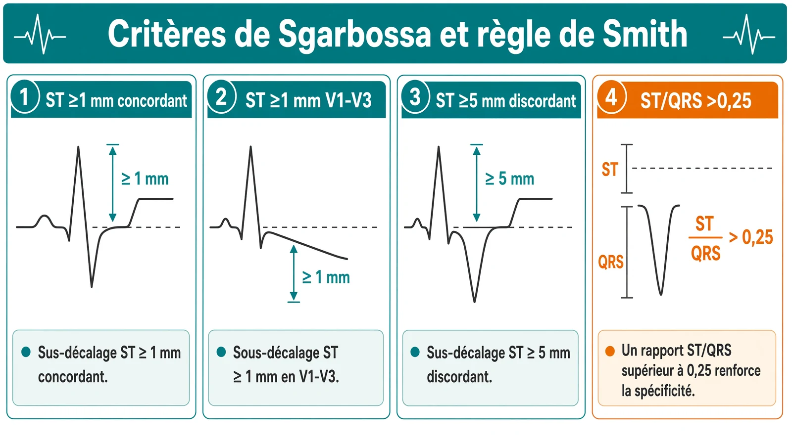 Quatre modules schématiques présentant les critères numériques de Sgarbossa et le seuil ST/QRS de Smith pour l’ECG stimulé